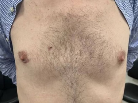 Minimal scarring after surgery - male